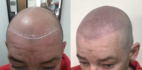 scalp micropigmentation for hair loss at Anthony James Hair Salon in Halifax