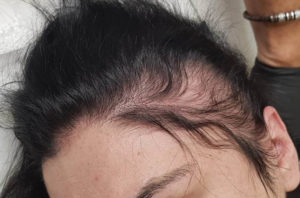 HAIR LOSS EXPERTS IN HALIFAX AT ANTHONY JAMES SALON