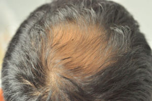 Scalp MicroPigmentation Hair Loss Solutions at Anthony James Hairdressers in Halifax