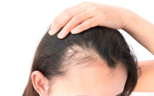 Hair Loss Covid-19, Anthony James Hair Salon in Halifax